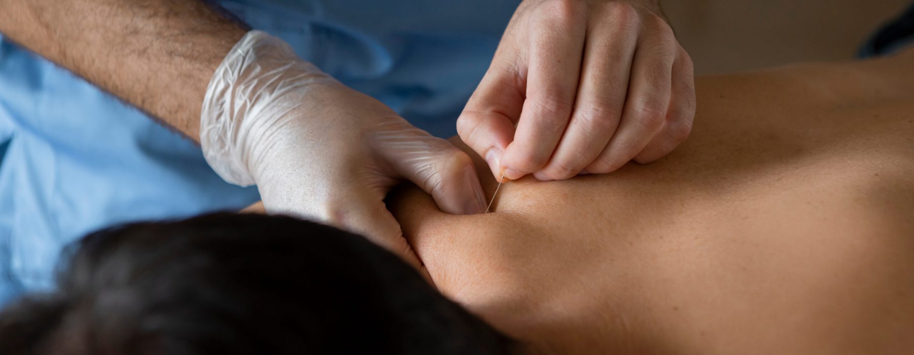 Middenstuk van handen in handschoenen van een fysiotherapeut of arts die een dry needling behandeling uitvoert bij een mannelijke patiënt met rugpijn.